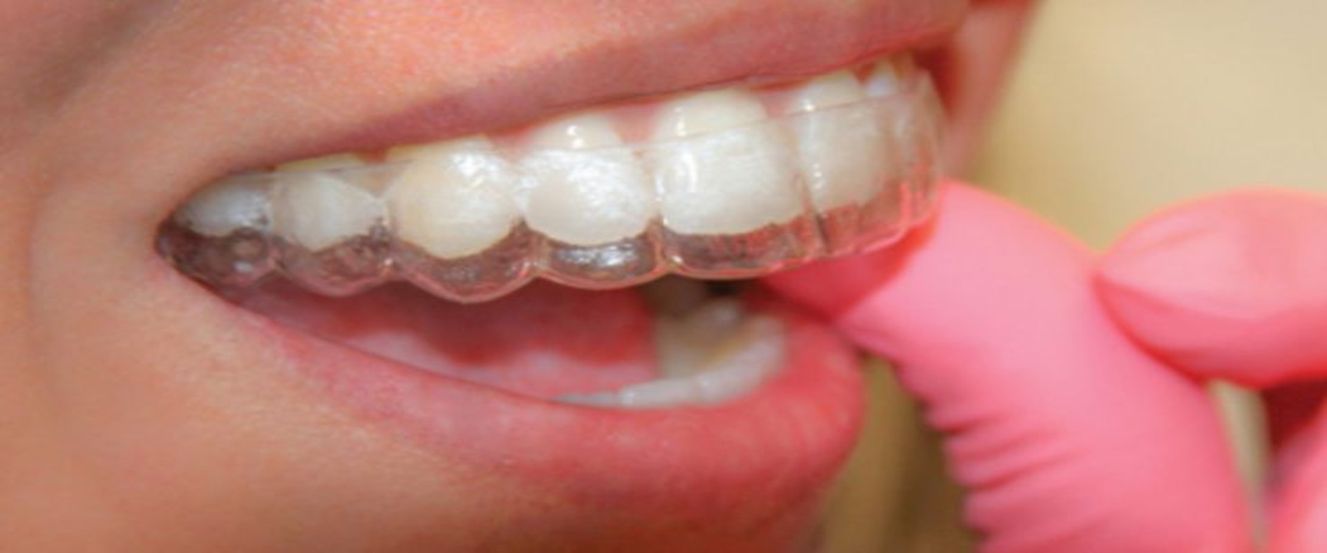 blog_the_benefits_of_early_orthodonics_intervention2